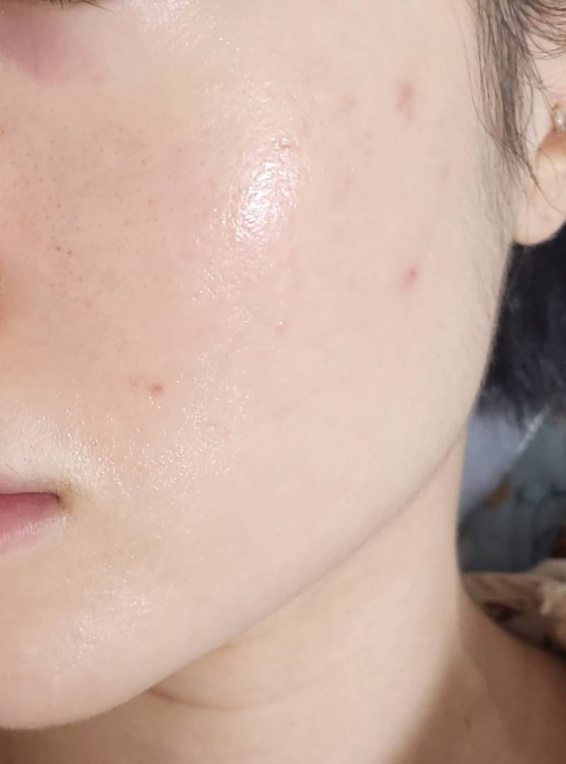[잡담] 여드름자국 이거 없어지긴하겠지 | 인스티즈