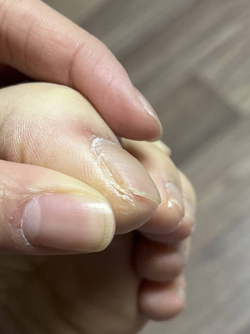 [잡담] 이거 내성발톱인가요? 너무 아파요🥲(혐오주의) 발 더러워요ㅜㅜ | 인스티즈