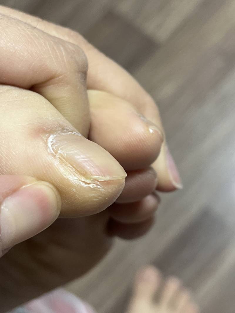 [잡담] 이거 내성발톱인가요? 너무 아파요🥲(혐오주의) 발 더러워요ㅜㅜ | 인스티즈