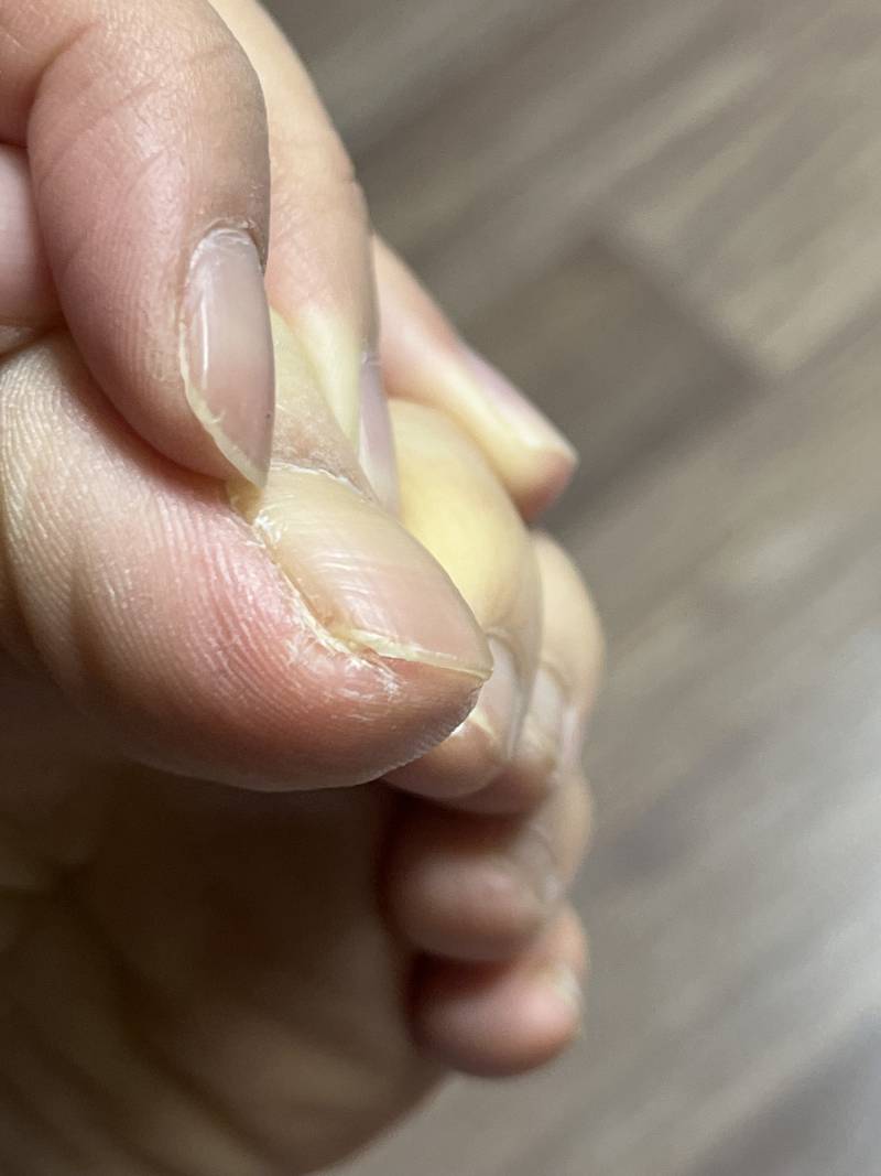 [잡담] 이거 내성발톱인가요? 너무 아파요🥲(혐오주의) 발 더러워요ㅜㅜ | 인스티즈