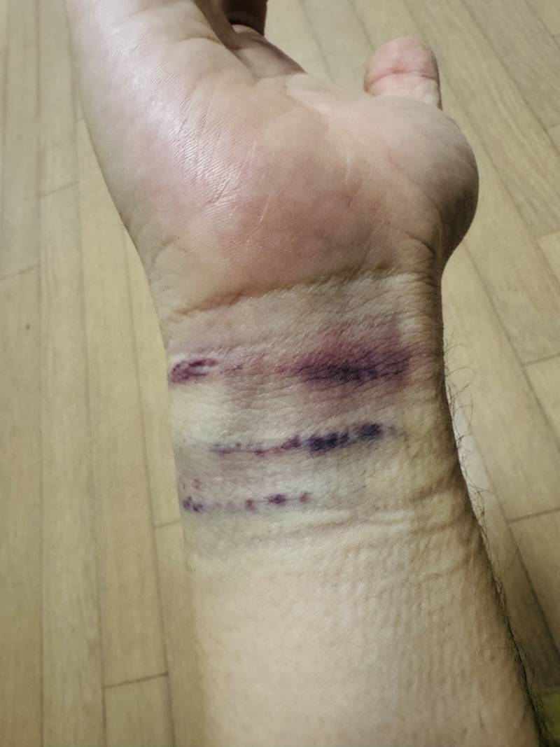 [잡담] 손목에 근육주사 맞으면 원래 이렇게 되는거야? ㅎㅇㅈㅇ | 인스티즈