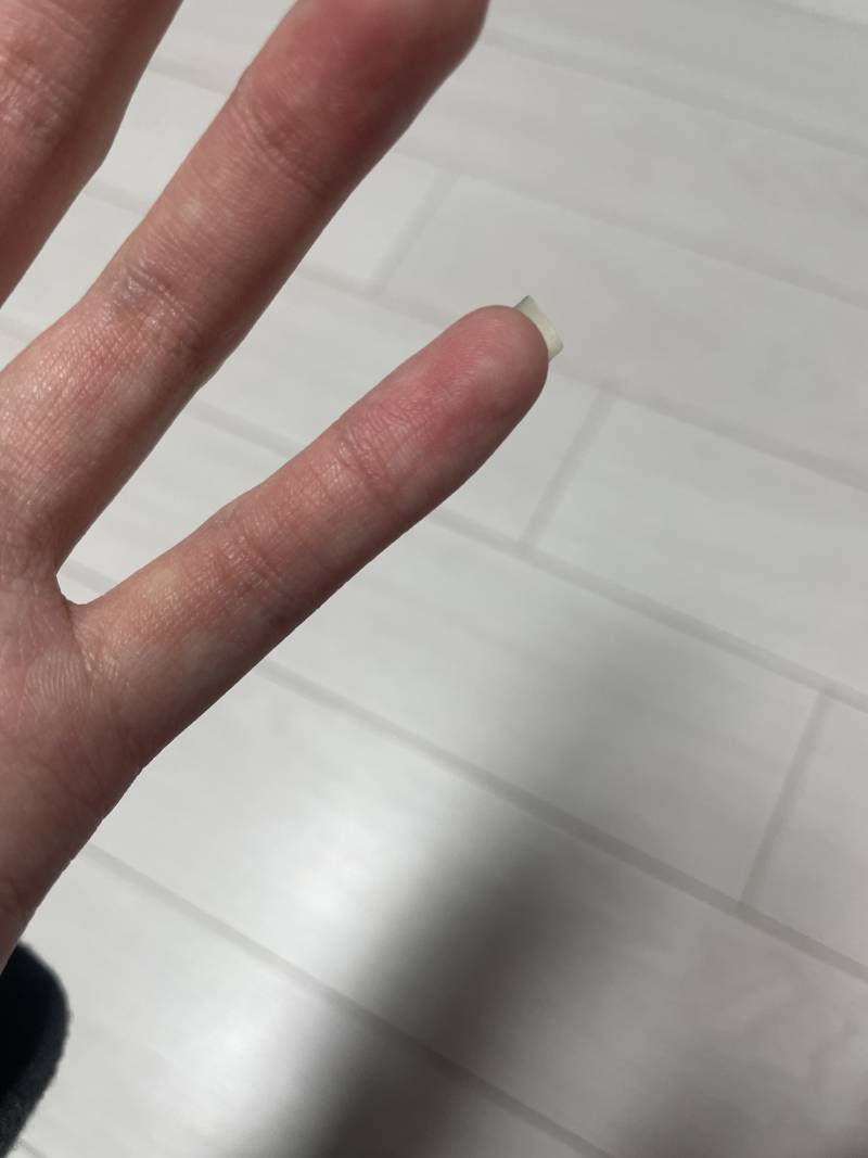 [잡담] 의사나 간호사 익들 이거 손가락 골절이야?? | 인스티즈