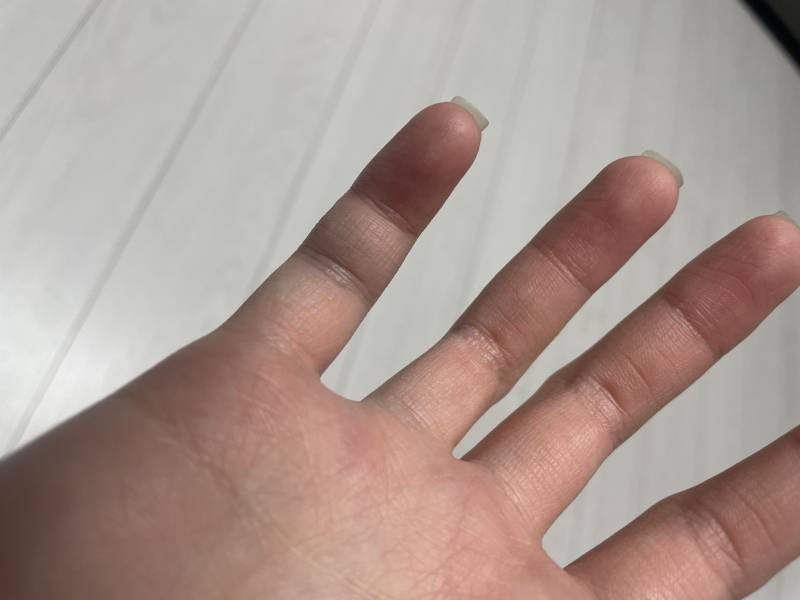 [잡담] 의사나 간호사 익들 이거 손가락 골절이야?? | 인스티즈
