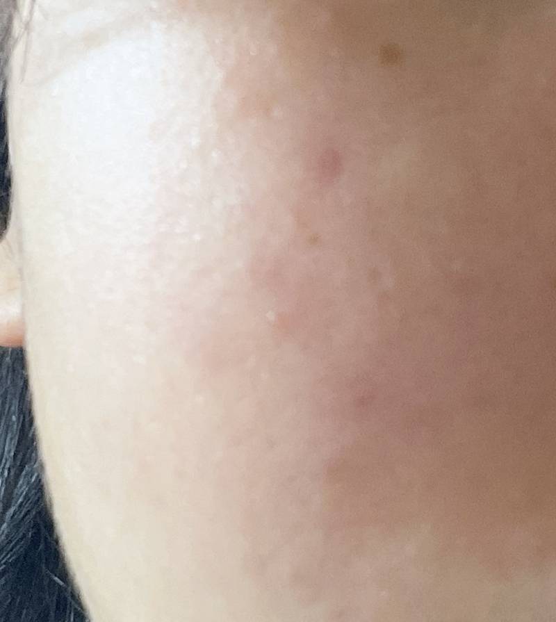 [잡담] 이거 모낭염이야? 아님 걍 여드름일까?ㅠ | 인스티즈