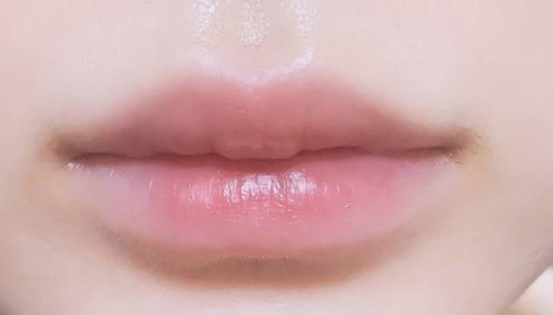 [잡담] 입술필러 2번맞음 | 인스티즈