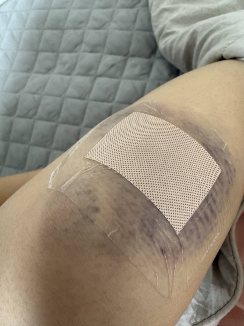[잡담] 어제 네번 넘어져서 너무아파 | 인스티즈