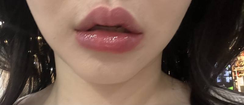 [잡담] 🆘도와줘 입술 필러 맞고 이만큼 부을 수 있나?? | 인스티즈