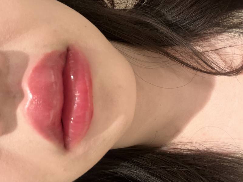 [잡담] 🆘도와줘 입술 필러 맞고 이만큼 부을 수 있나?? | 인스티즈