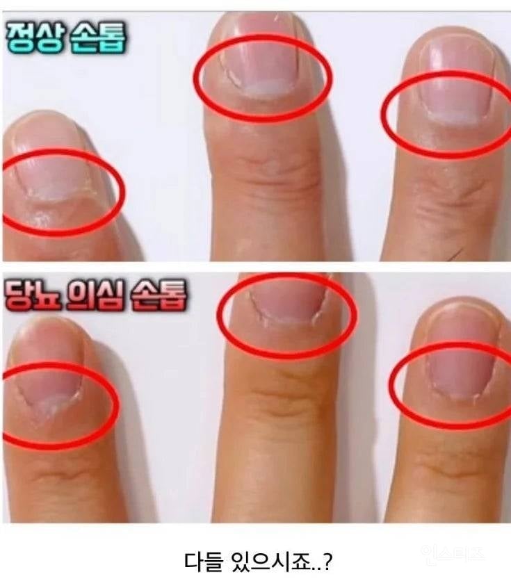 한의사 피셜 당뇨 진단법. jpg | 인스티즈