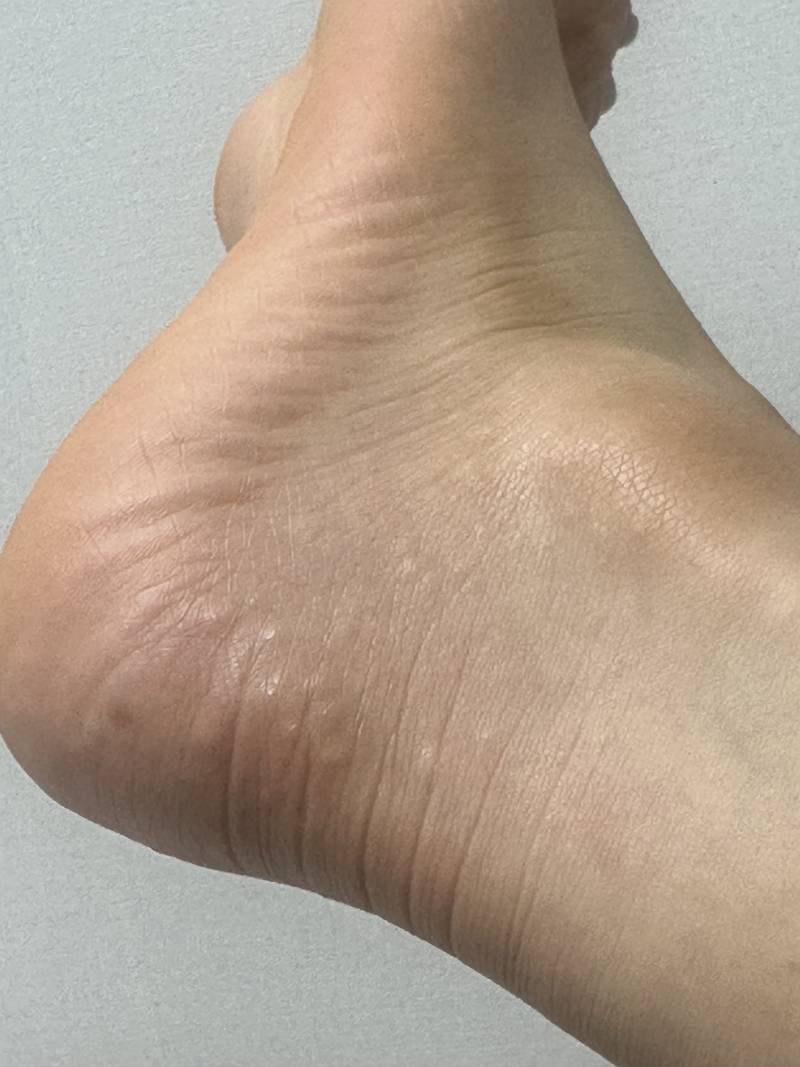 [잡담] 갑자기 발에 이런게 낫는데 봐줘 ㅠㅠㅠㅠㅠ | 인스티즈