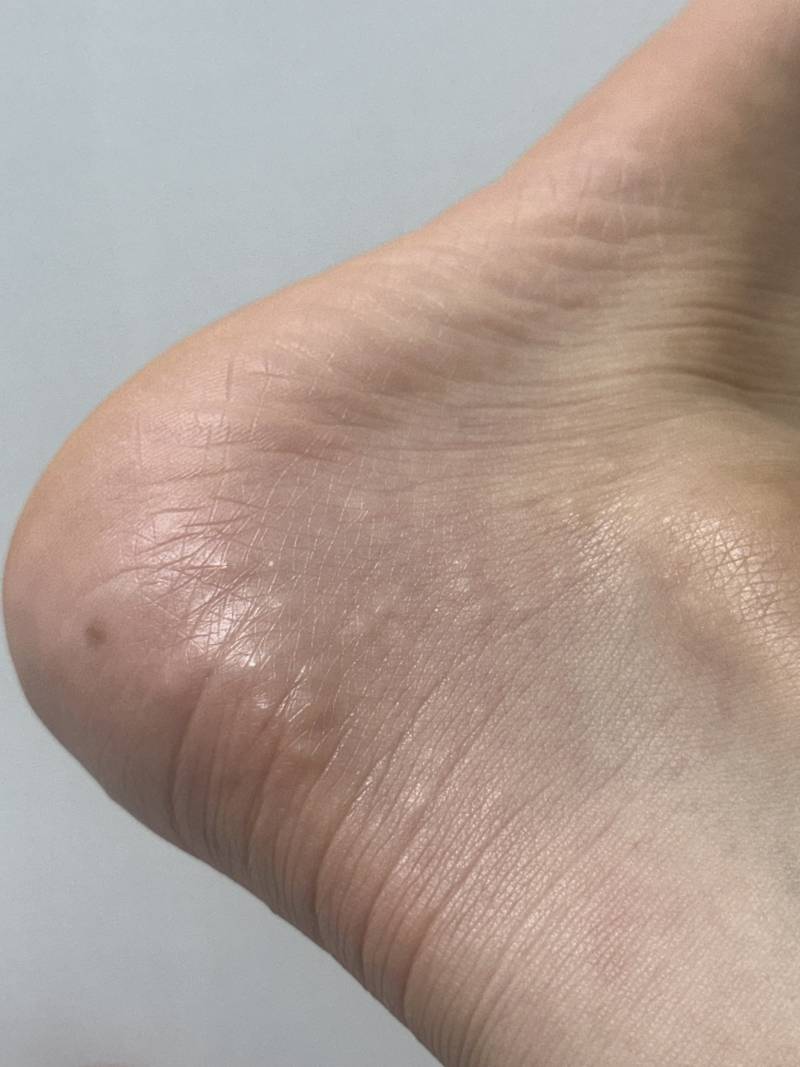 [잡담] 갑자기 발에 이런게 낫는데 봐줘 ㅠㅠㅠㅠㅠ | 인스티즈