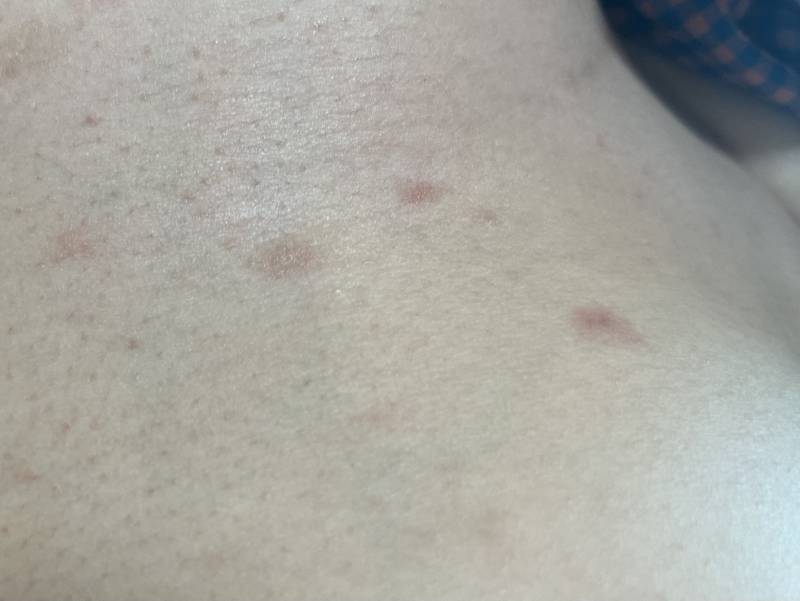 [잡담] 나 몸에 이런 빨간 반점들이 났는데 대체 뭘까…?ㅠ | 인스티즈