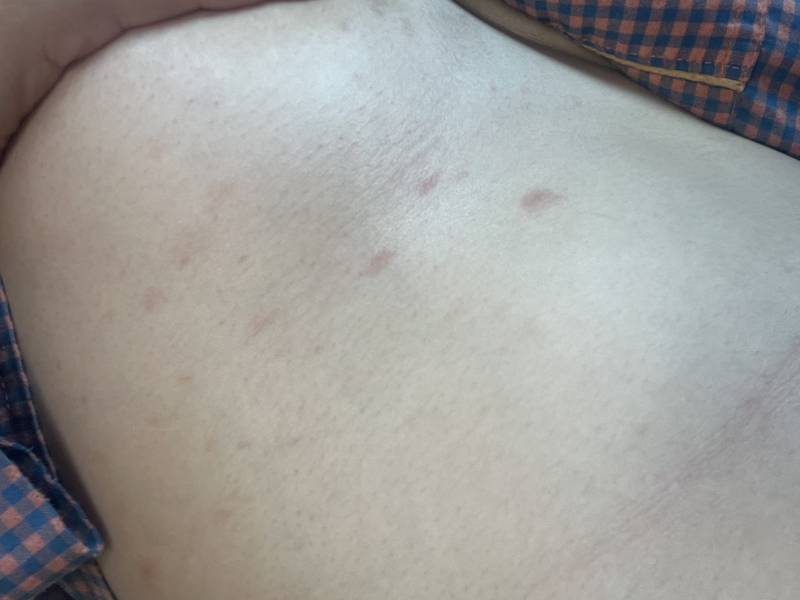 [잡담] 나 몸에 이런 빨간 반점들이 났는데 대체 뭘까…?ㅠ | 인스티즈