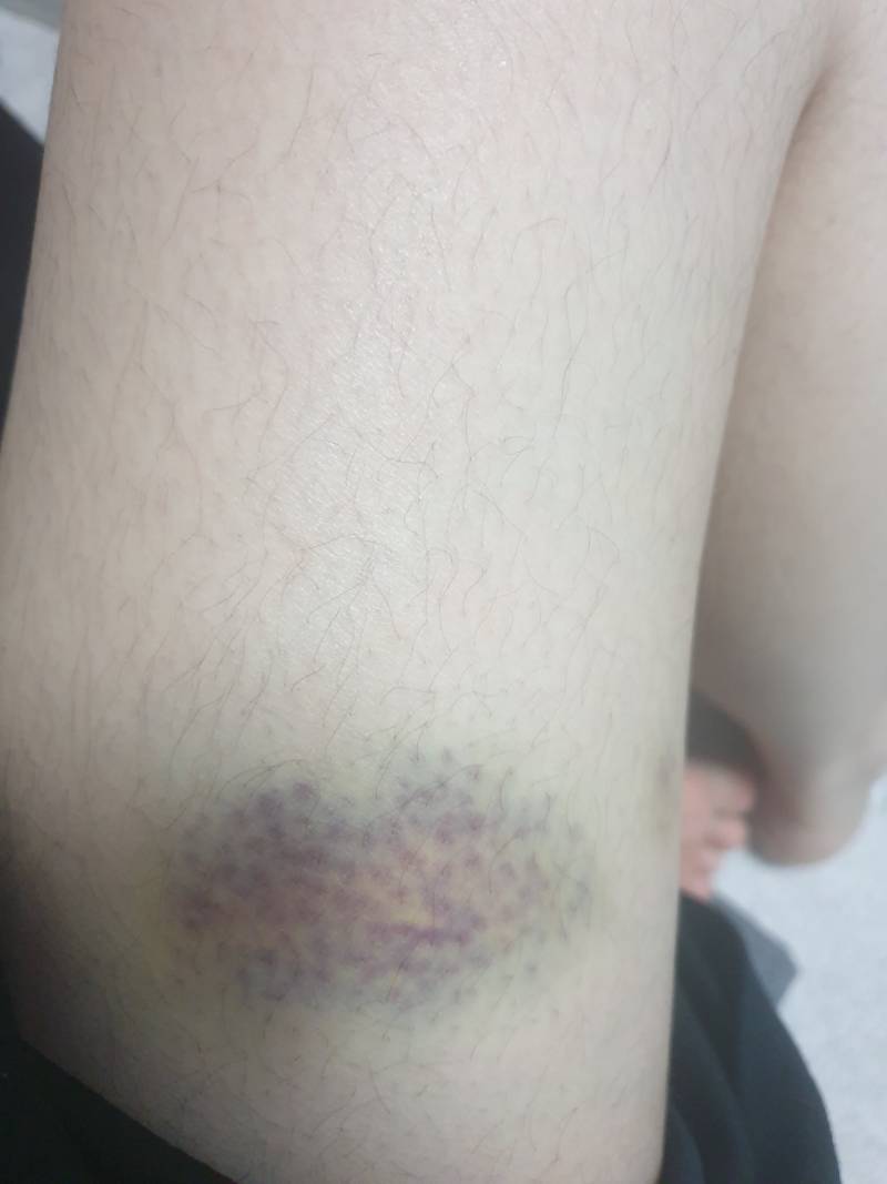 [잡담] 와 나 허벅지 좀 부딪혔는데 무슨 멍이 이렇게 드냐(털주의) | 인스티즈