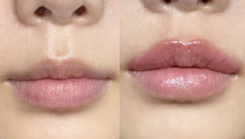 [잡담] 입술필러랑 문신중에 뭐가 나아? | 인스티즈