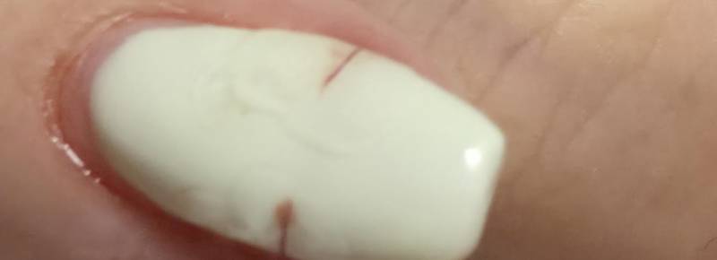 [잡담] 손톱 깨져서 피나는데 어떻게 해야 돼 ㅠㅠㅠ | 인스티즈