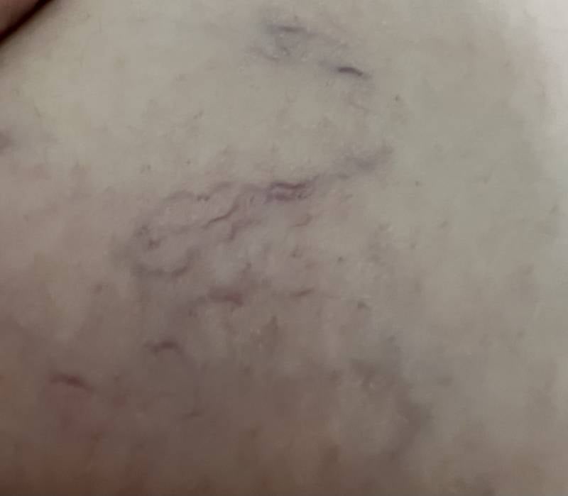 [잡담] 하지정맥 이정도면 병원가야해..? 징그러움 주의 | 인스티즈