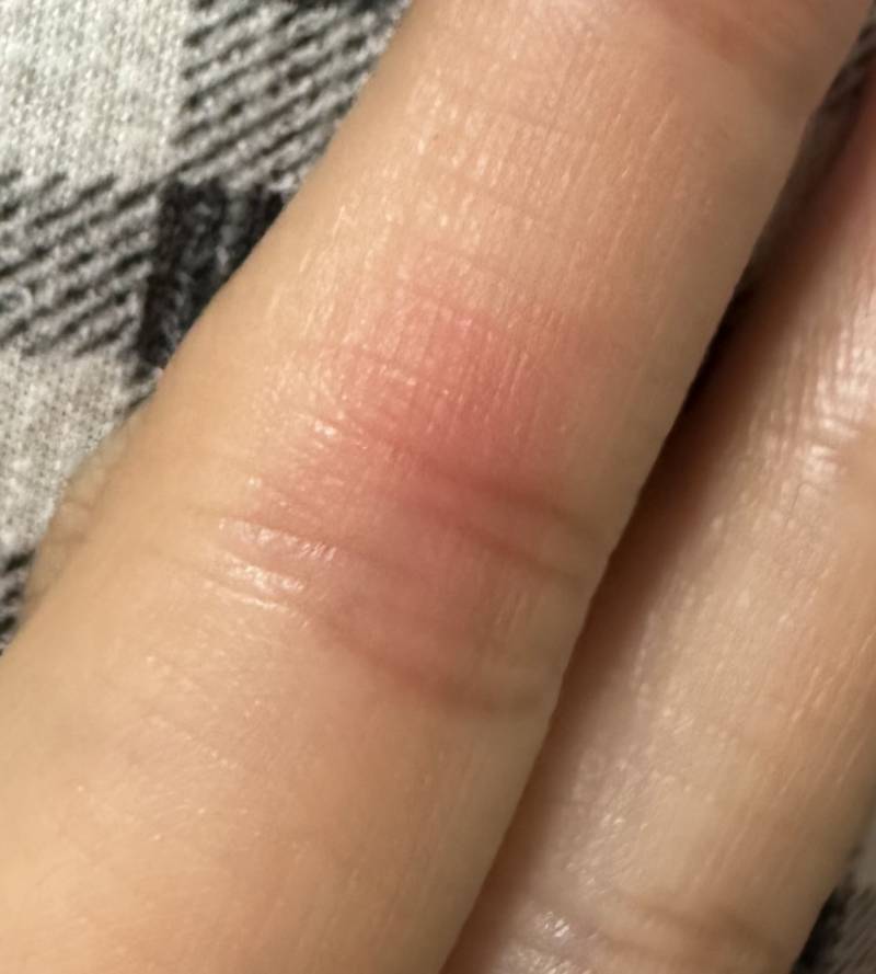 [잡담] 손가락 안쪽 마디가 빨갛고 따가운데 왜그럴까ㅜㅜ | 인스티즈