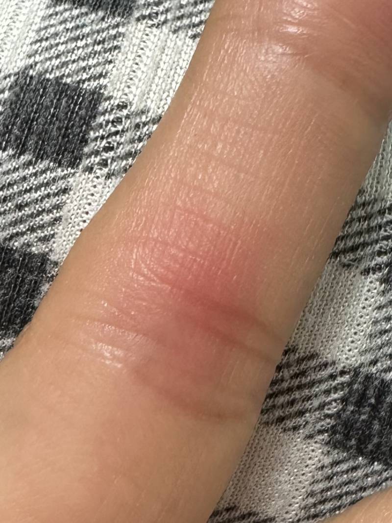 [잡담] 손가락 안쪽 마디가 빨갛고 따가운데 왜그럴까ㅜㅜ | 인스티즈