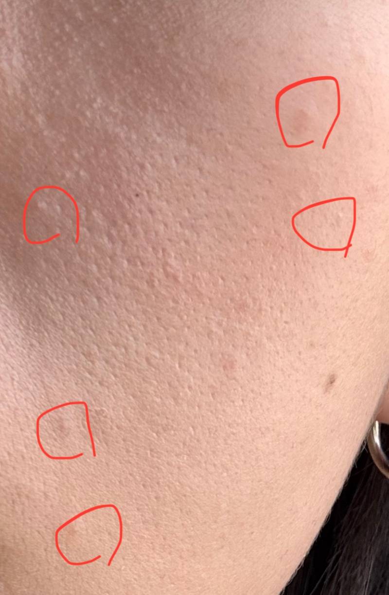 [잡담] 혹시 이 뽀루지? 여드름? 뭐라고 부르는 지 알아? 혐오주의 | 인스티즈