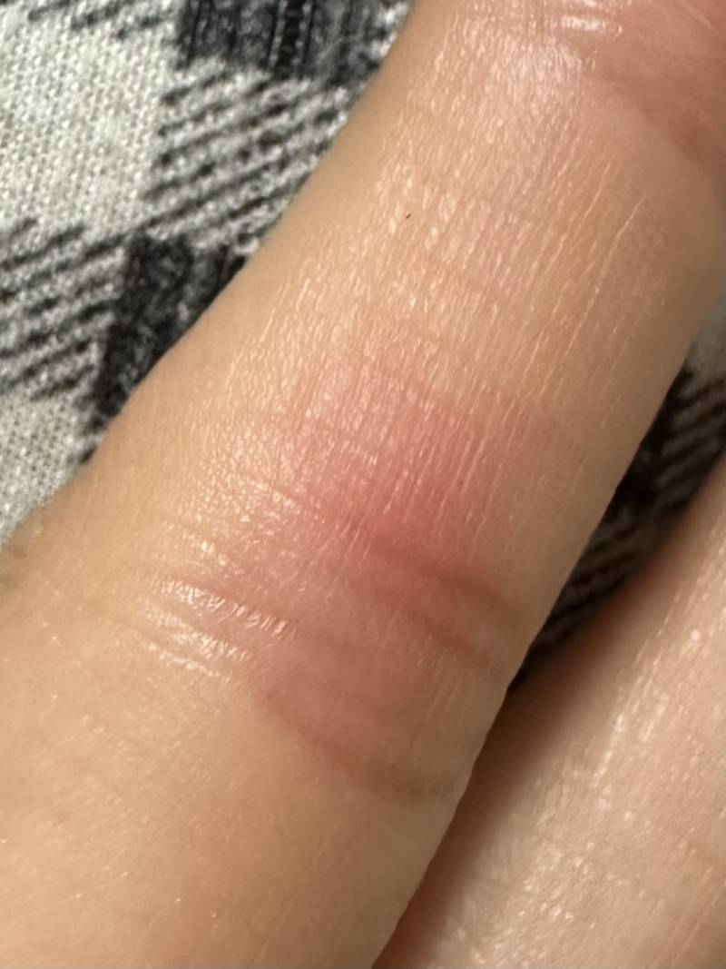 [잡담] 손가락 안쪽 마디가 빨갛고 따가운데 왜그럴까ㅜㅜ | 인스티즈