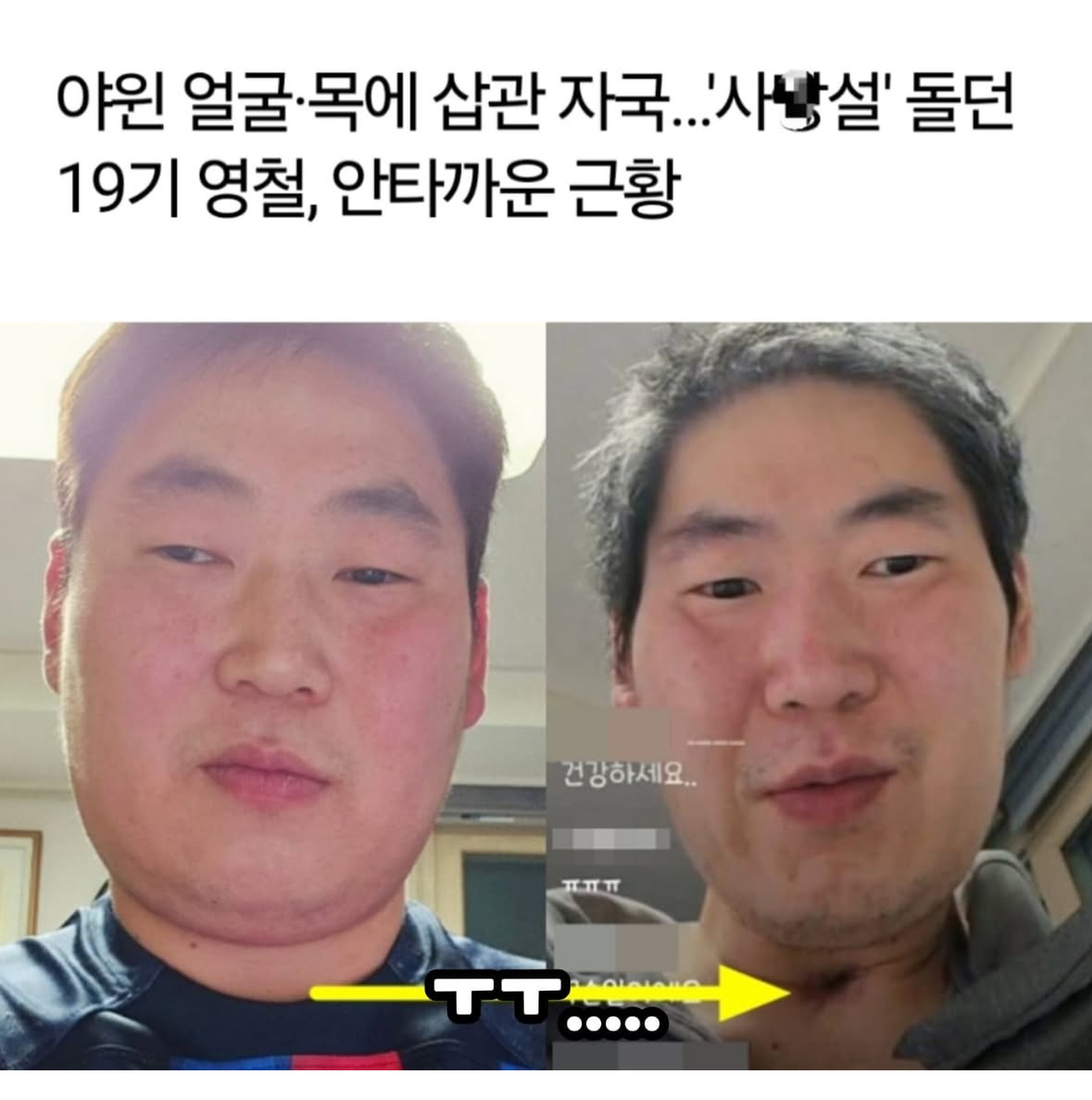[잡담] 나는 솔로 19기 영철 암걸렸다네.. | 인스티즈