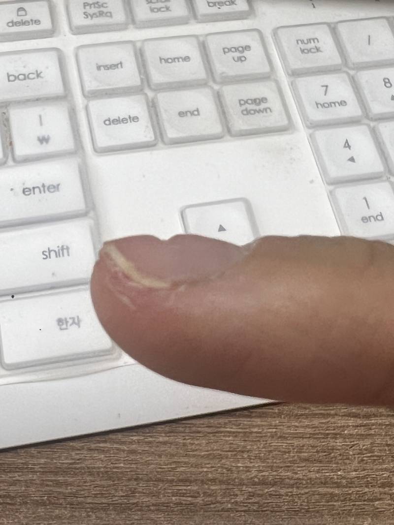 [잡담] 손톱 어디 찧은적도 없는데 이렇게 남 | 인스티즈