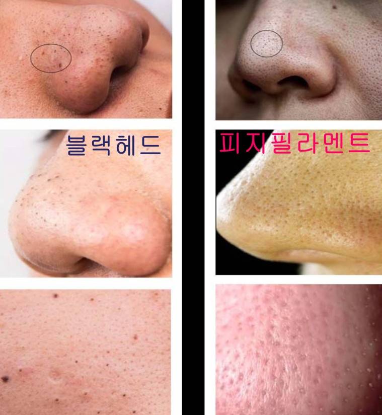 [잡담] 블랙헤드 연구(?) 하다가 여기까지 알게됨 | 인스티즈