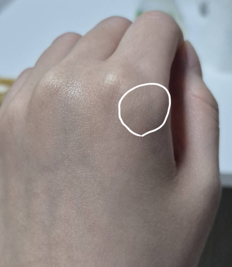 [잡담] 손등 뼈쪽에 멍들거나 부어본 익 있어?? ㅠ | 인스티즈