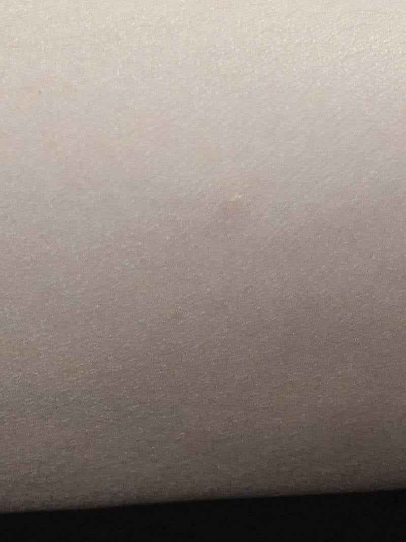 [잡담] 팔에도 여드름이 나??.. | 인스티즈