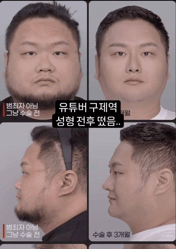 [잡담] 사이버렉카 구제역인가 그사람 성형했대 | 인스티즈