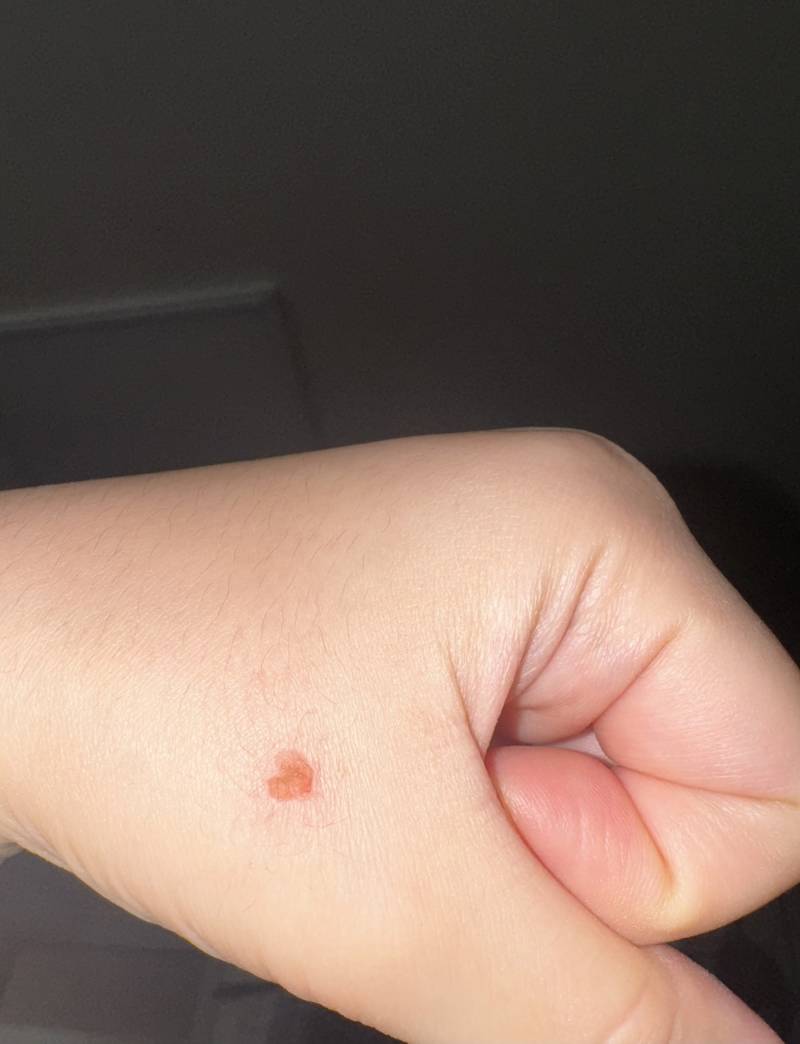 [잡담] 나 상처가 하트로 났어 ㅋㅋㅋㅋ | 인스티즈