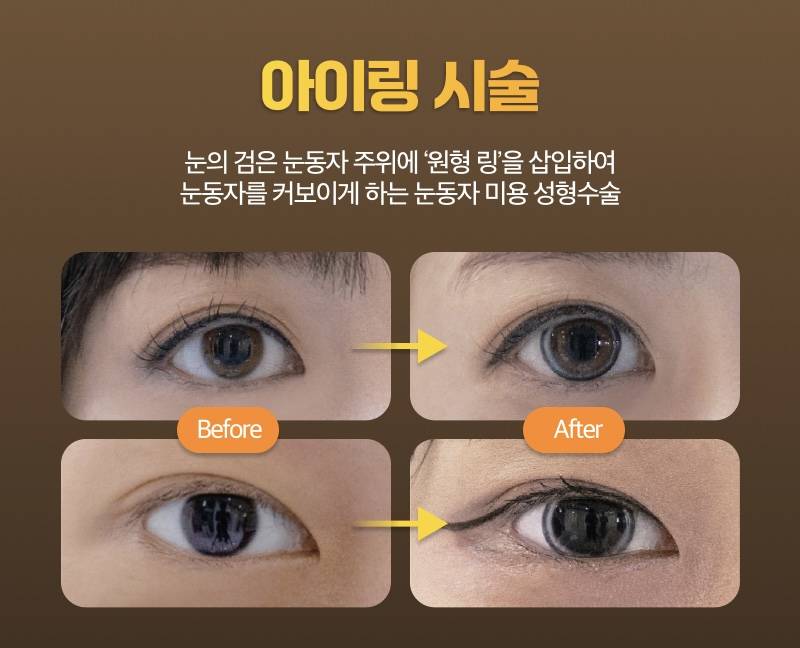[잡담] 아이링이란 수술알아? 진짜 기괴함 | 인스티즈