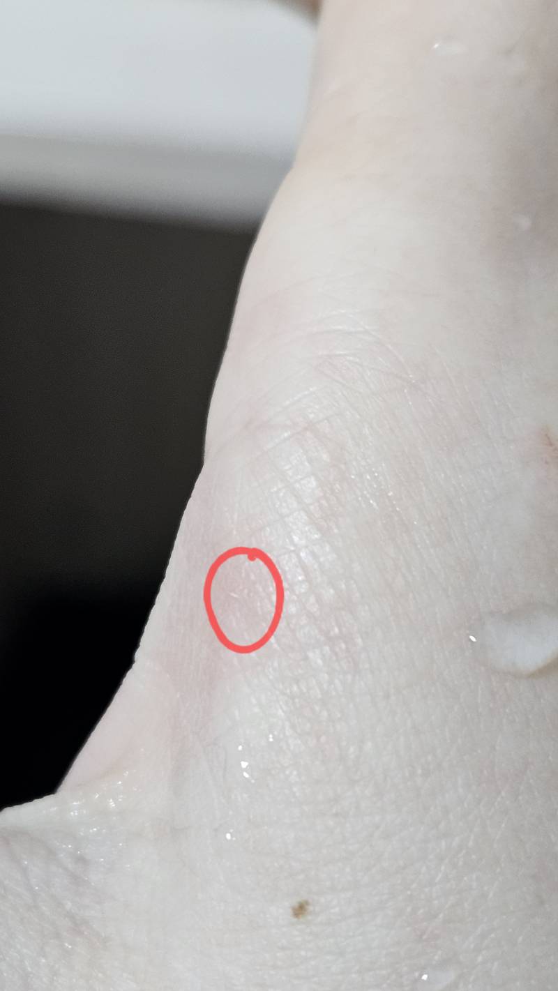 [잡담] 나무젓가락 사용하다가 손에 가시?가 박혔는데 이거 어떻게 빼?ㅠㅠㅠㅠㅠㅠ | 인스티즈