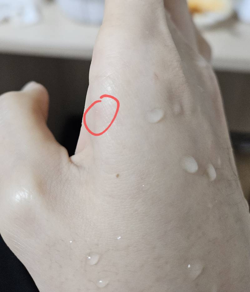 [잡담] 나무젓가락 사용하다가 손에 가시?가 박혔는데 이거 어떻게 빼?ㅠㅠㅠㅠㅠㅠ | 인스티즈