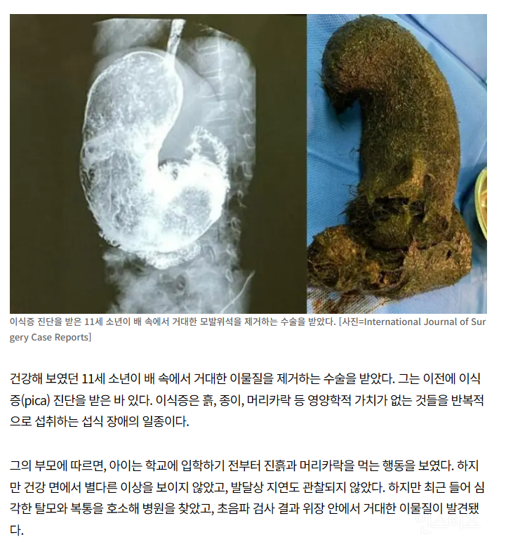 (사진주의)"진흙 덩어리? 11세 배 속에 뭐야?"...거대한 정체 봤더니, 소년이 먹은 것들에 경악 | 인스티즈