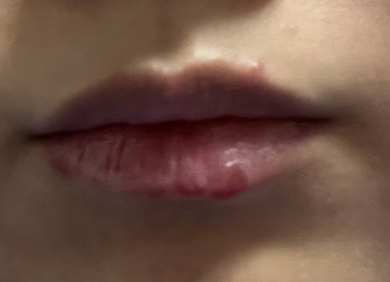 [잡담] 이거 헤르페스 맞아?ㅜㅠ | 인스티즈