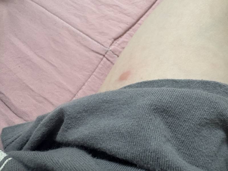 [잡담] 팔에 이거머야? 가려우ㅜㅠㅠ | 인스티즈