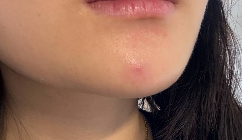[잡담] 익들아 이 뾰루지 염증주사 맞으면 괜찮아질까?..(사진주의) | 인스티즈
