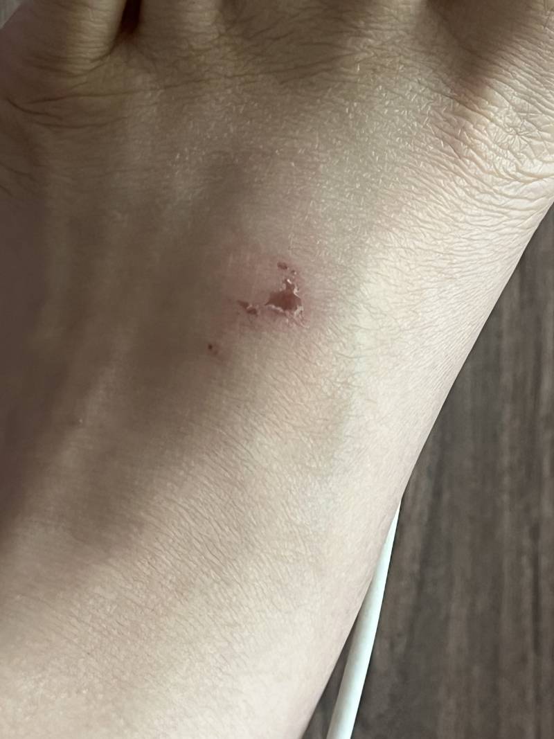 [잡담] 이렇게 긁어서 생긴 상처에는 뭐 붙여야돼?(혐오주의) | 인스티즈