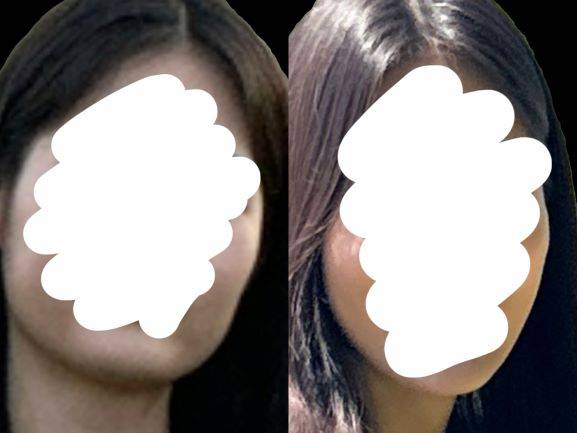 [잡담] 난 진짜 보톡스 효과 좋은듯... | 인스티즈