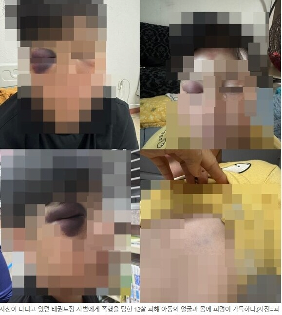 [정보/소식] 태권도 관장에게 폭행당한 12세 아이 자세한 사진.. | 인스티즈
