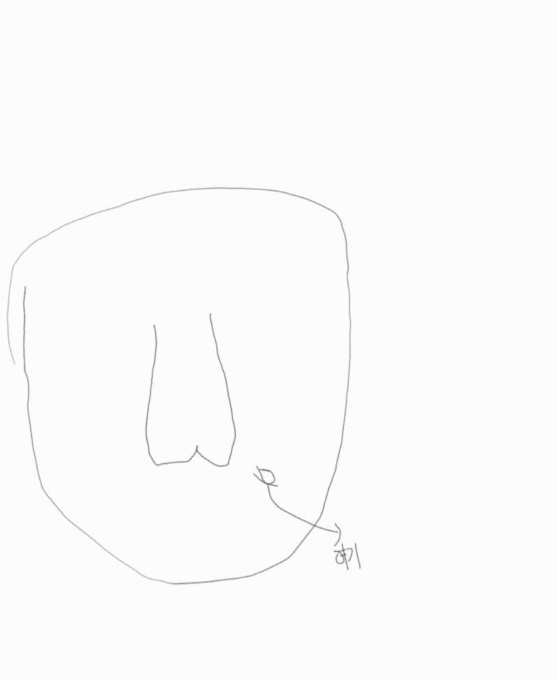 [잡담] 나 진짜 점 흉터 때문에 스트레스 심한데 제거하면 괜찮을까 | 인스티즈