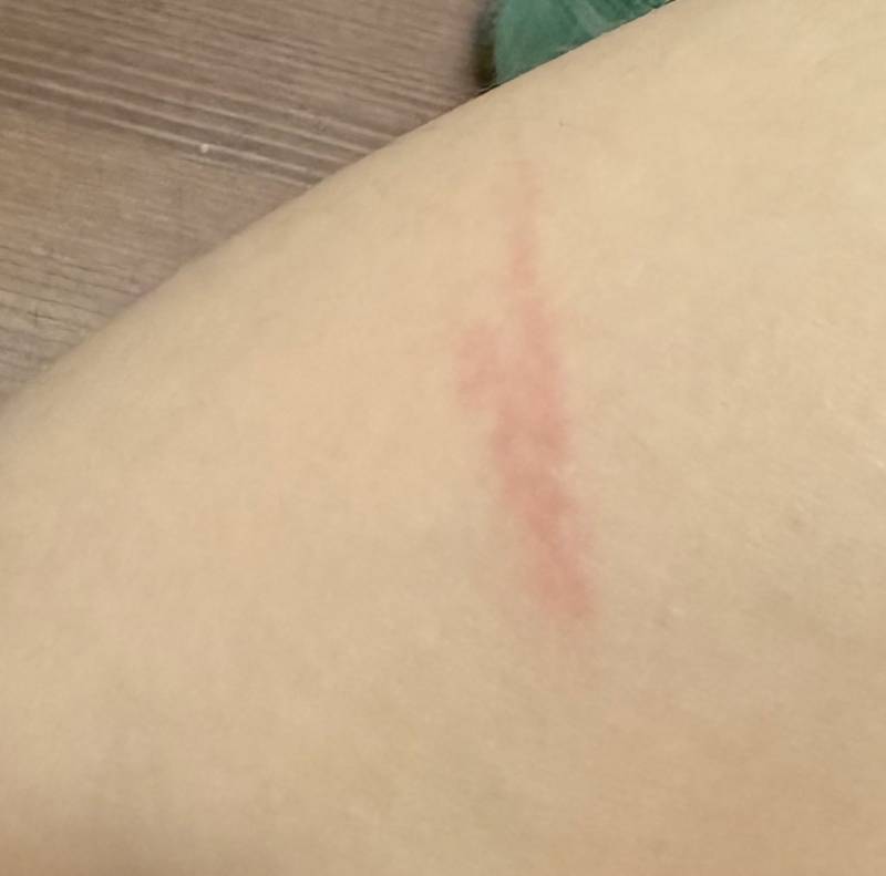 [잡담] 화상 경험자들아ㅜㅜ | 인스티즈