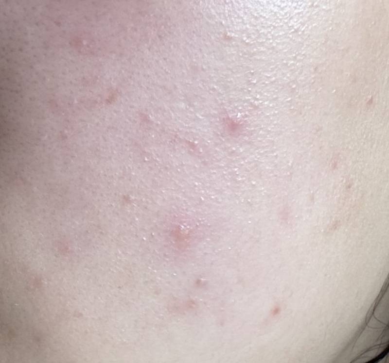 [잡담] 피부 하루아침에 갑자기 이런데 뭐지..? ㅎㅇㅈㅇ | 인스티즈