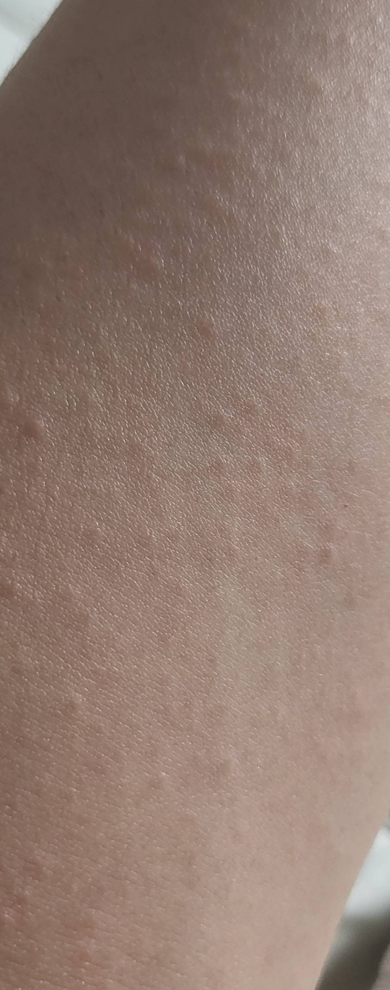 [잡담] 양쪽 팔에 오돌토돌 뭐 올라왔는데 뭔지 봐줄 익??ㅜㅜ | 인스티즈