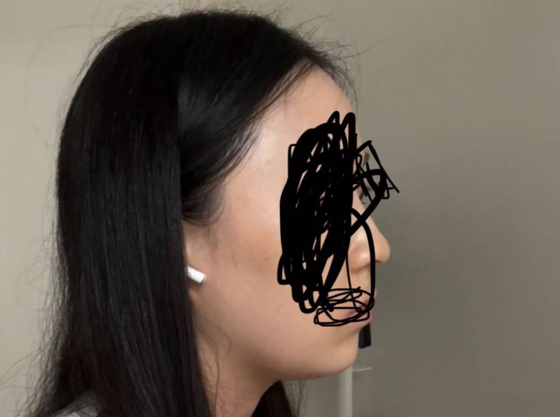 [잡담] 혹시 턱에 살 조금이라도 찐거같아? 아나몀 빠진거같아? 아니몀 똑같아? 솔직하게 봐주라! | 인스티즈