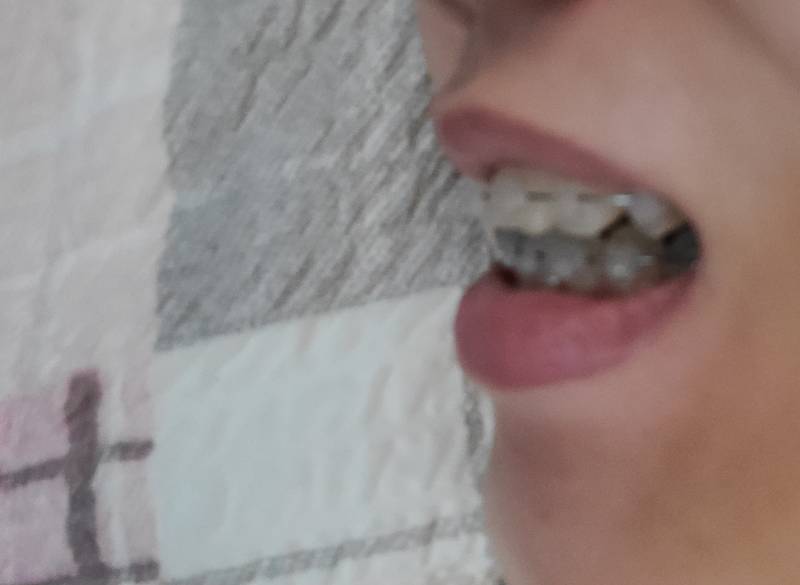 [잡담] 교정한친구들아.. 비발치 뻗침 봐주라 | 인스티즈