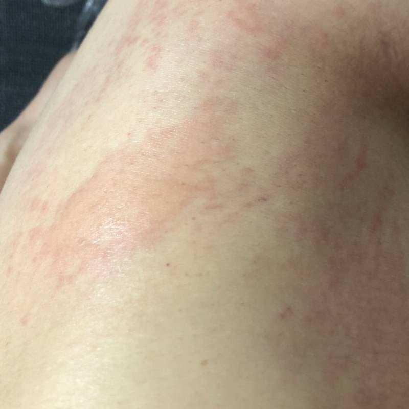 [잡담] (혐주의) 위고비 맞고 두드러기 생김ㅎ | 인스티즈