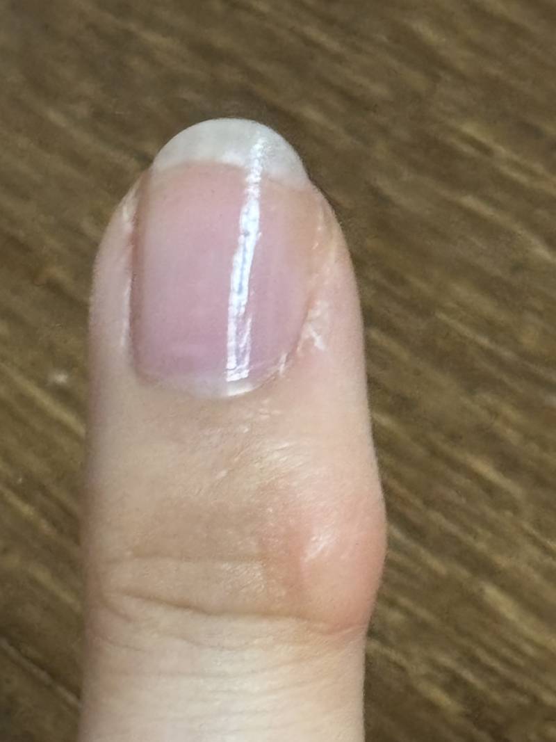 [잡담] 손가락 굳은살 제거 못하나? | 인스티즈